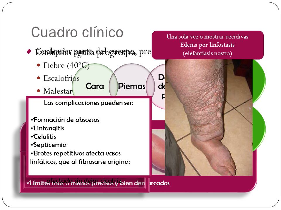 complicaciones de la celulitis en las piernas